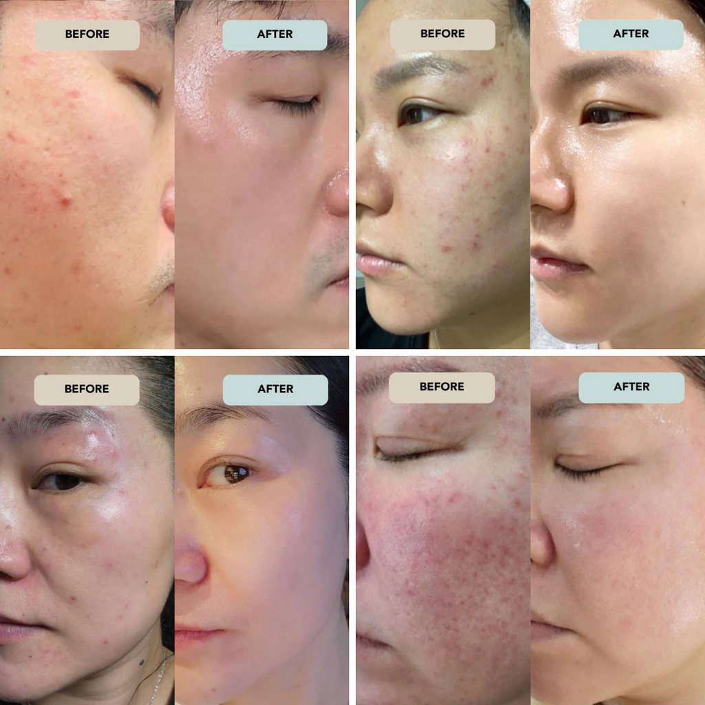 The #1 Korean Skincare Line Transforms Teenage Acne Prone Skin in America