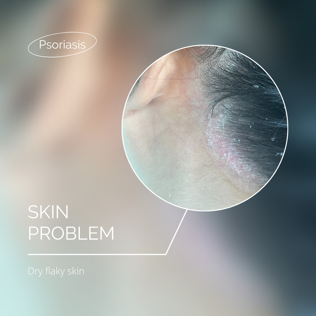 Embracing Radiant Skin: Managing Psoriasis with the Healing Touch of Korean Skincare
